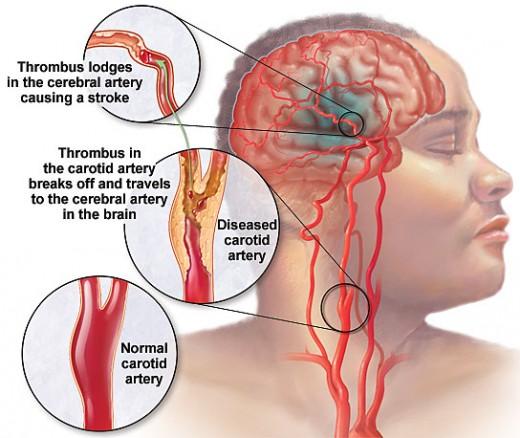 Schema trombolisi trattamento farmacologico - Dott Giancarlo Stazi cardiologo