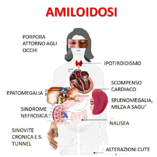 Segni Amiloidosi cardiaca
