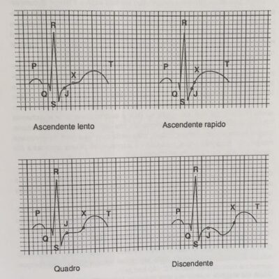 come leggere Tratto ST di elettrocardiogramma