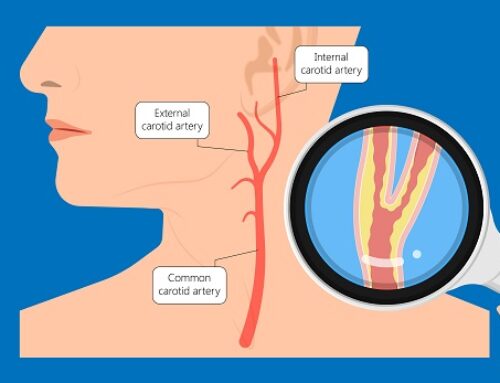 Patologia steno ostruttiva carotidea: un apripista per l’ictus cerebrale